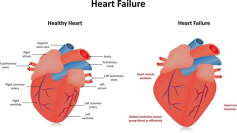 hypokinesis of the anteroseptal wall.